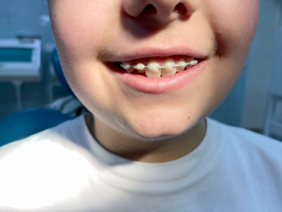 Чепецкие стоматологи пасли подростку зуб, принесенный в салфетке